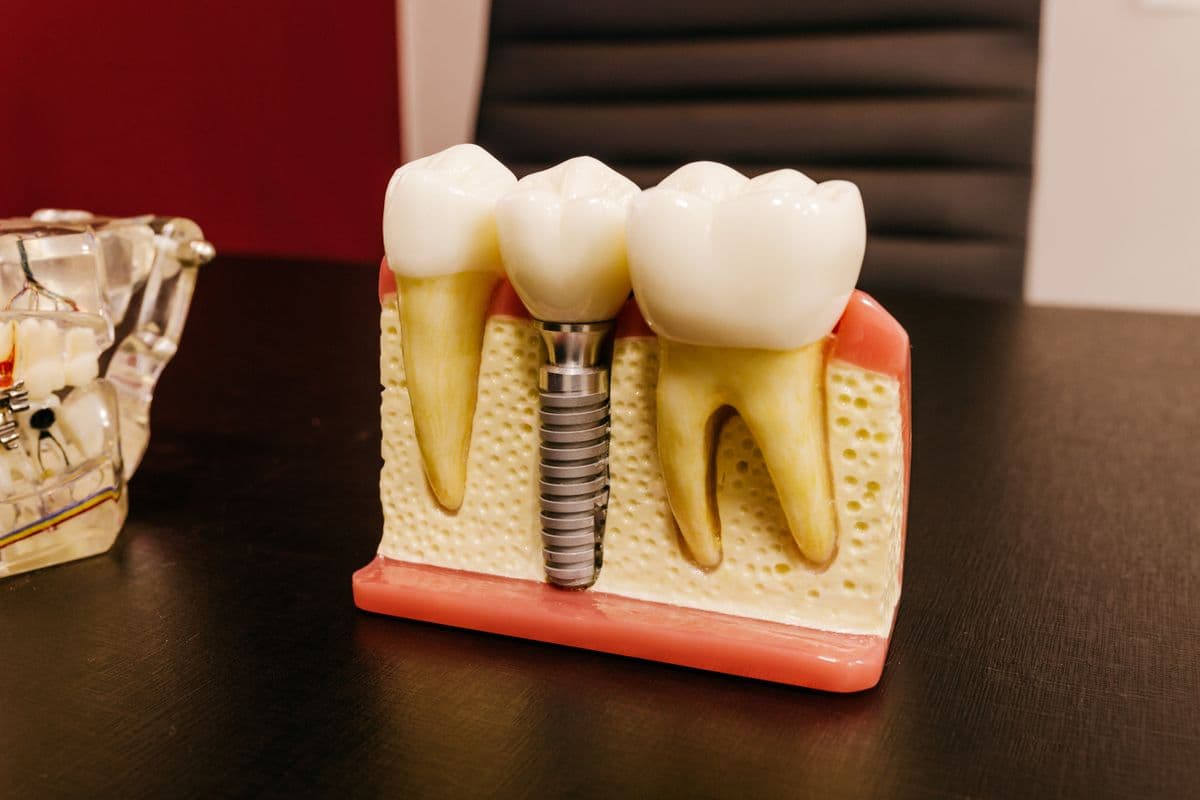 A dental implant model showing a titanium post between natural teeth